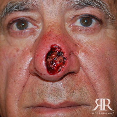 Mohs Surgery Before & After Gallery - Patient 148396 - Image 1