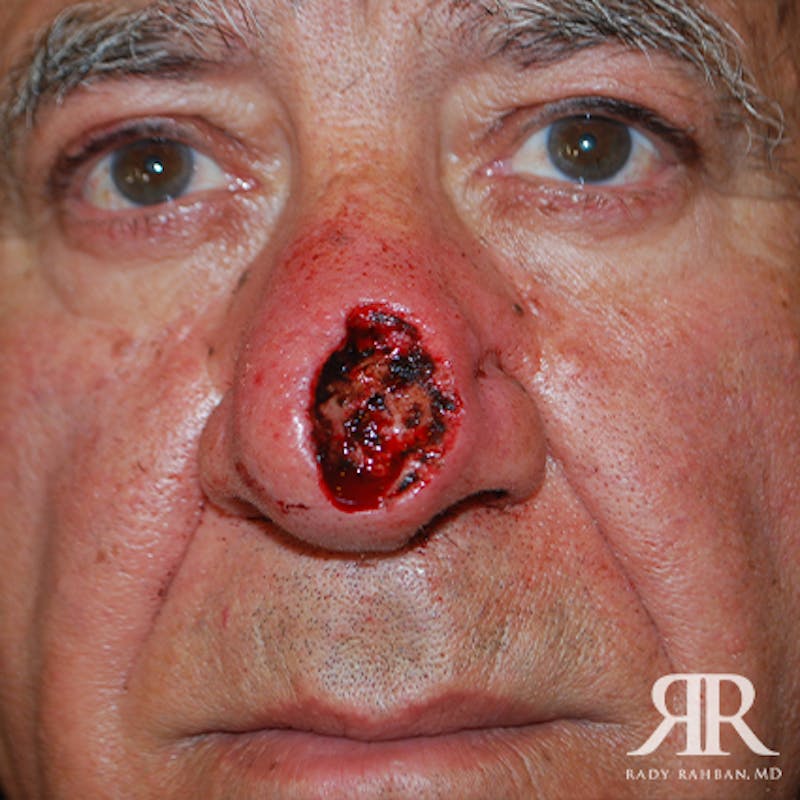 Mohs Surgery Before & After Gallery - Patient 148396 - Image 1