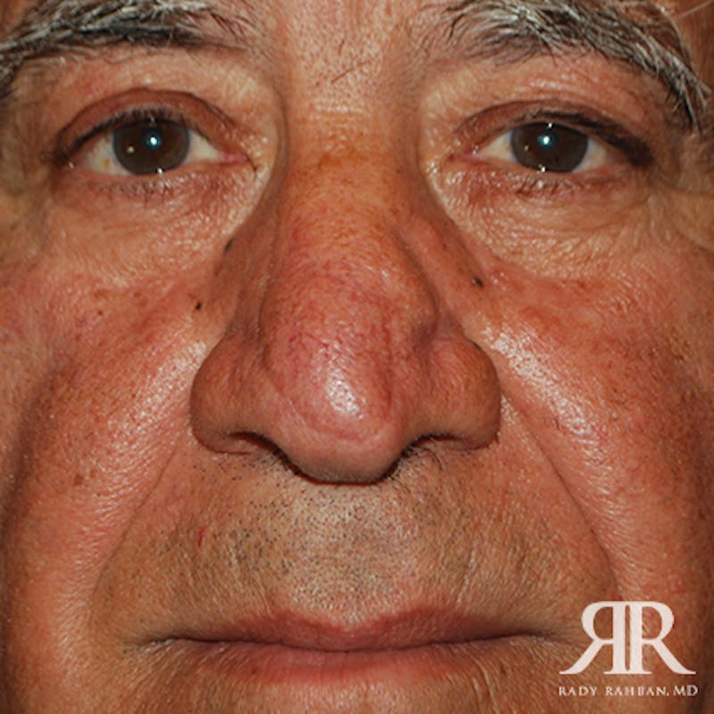 Mohs Surgery Before & After Gallery - Patient 148396 - Image 2
