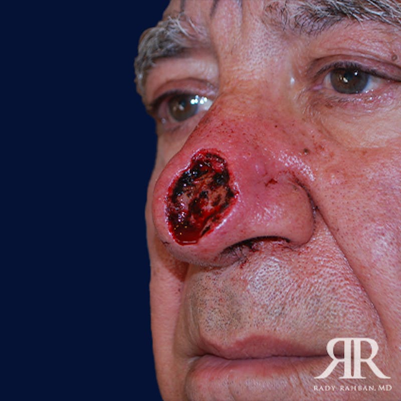 Mohs Surgery Before & After Gallery - Patient 148396 - Image 3