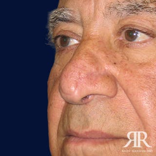 Mohs Surgery Before & After Gallery - Patient 148396 - Image 4