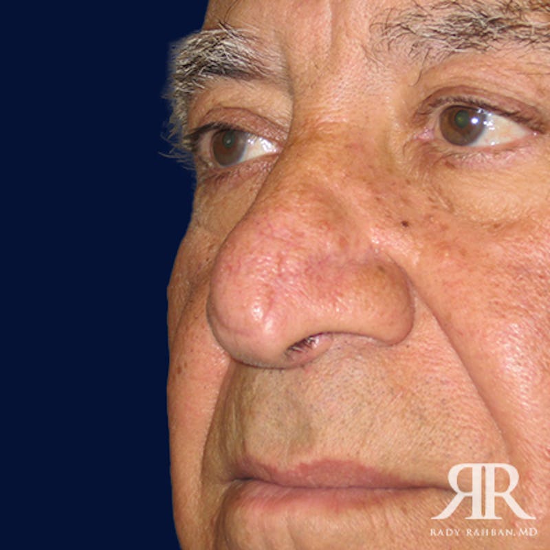 Mohs Surgery Before & After Gallery - Patient 148396 - Image 4