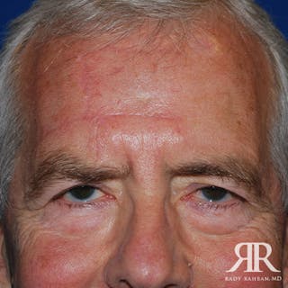 Mohs Surgery Before & After Gallery - Patient 900843 - Image 2