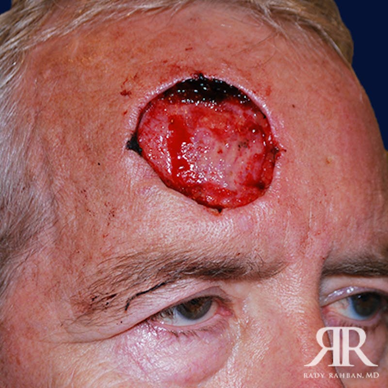 Mohs Surgery Before & After Gallery - Patient 900843 - Image 3