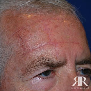 Mohs Surgery Before & After Gallery - Patient 900843 - Image 4