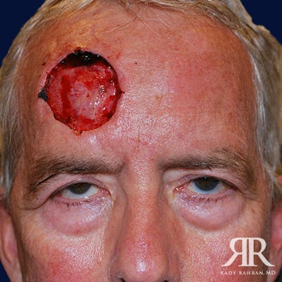 Mohs Surgery Before & After Gallery - Patient 900843 - Image 1