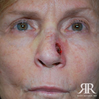 Mohs Surgery Before & After Gallery - Patient 233355 - Image 1