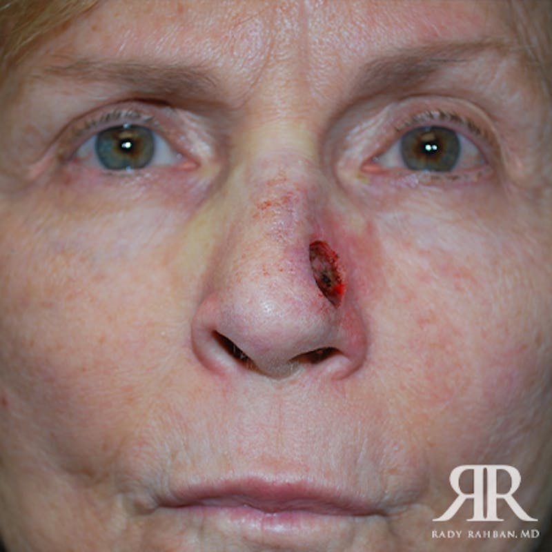 Mohs Surgery Before & After Gallery - Patient 233355 - Image 1