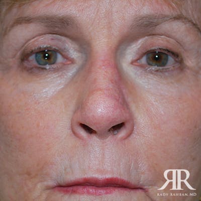Mohs Surgery Before & After Gallery - Patient 233355 - Image 2