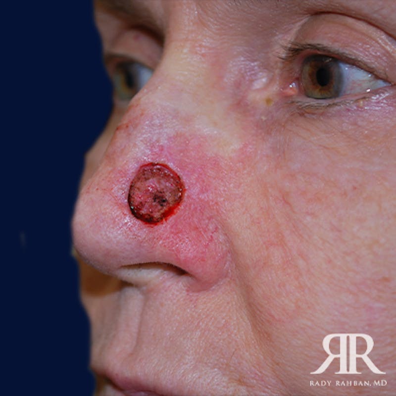 Mohs Surgery Before & After Gallery - Patient 233355 - Image 3