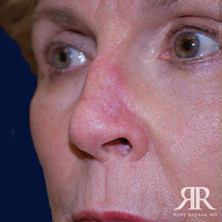 Mohs Surgery Before & After Gallery - Patient 233355 - Image 4