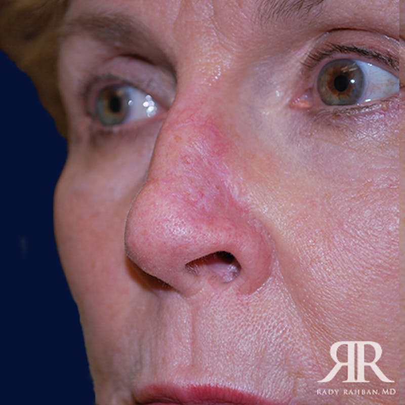 Mohs Surgery Before & After Gallery - Patient 233355 - Image 4