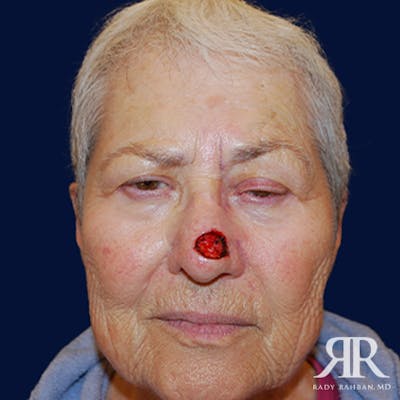 Mohs Surgery Before & After Gallery - Patient 344252 - Image 1