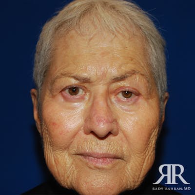 Mohs Surgery Before & After Gallery - Patient 344252 - Image 2