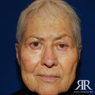 Mohs Surgery Before & After Gallery - Patient 344252 - Image 2
