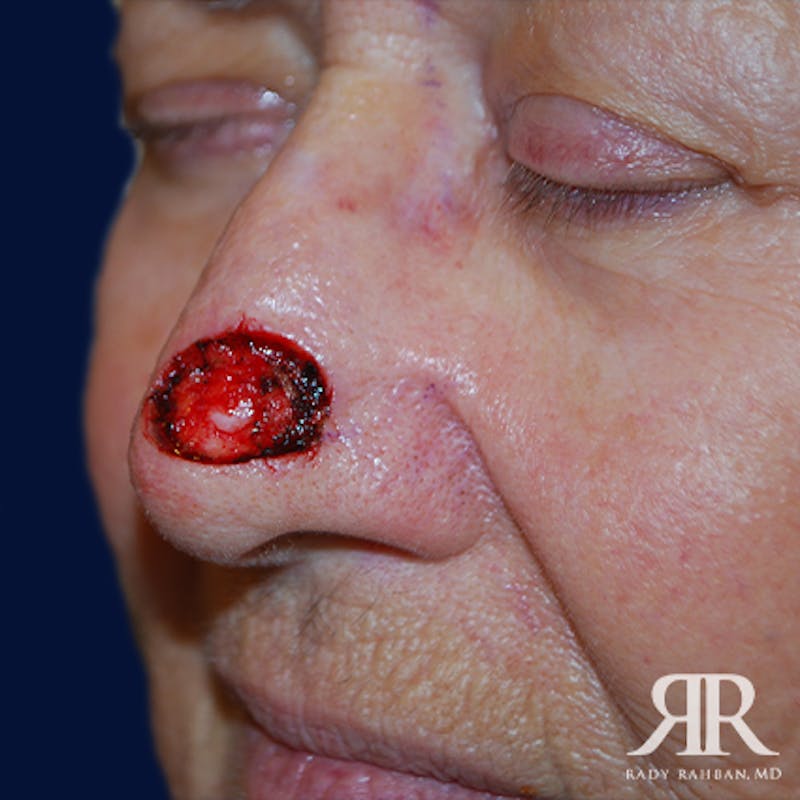 Mohs Surgery Before & After Gallery - Patient 344252 - Image 3
