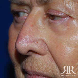 Mohs Surgery Before & After Gallery - Patient 344252 - Image 4