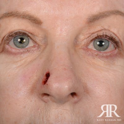 Mohs Surgery Before & After Gallery - Patient 329108 - Image 1