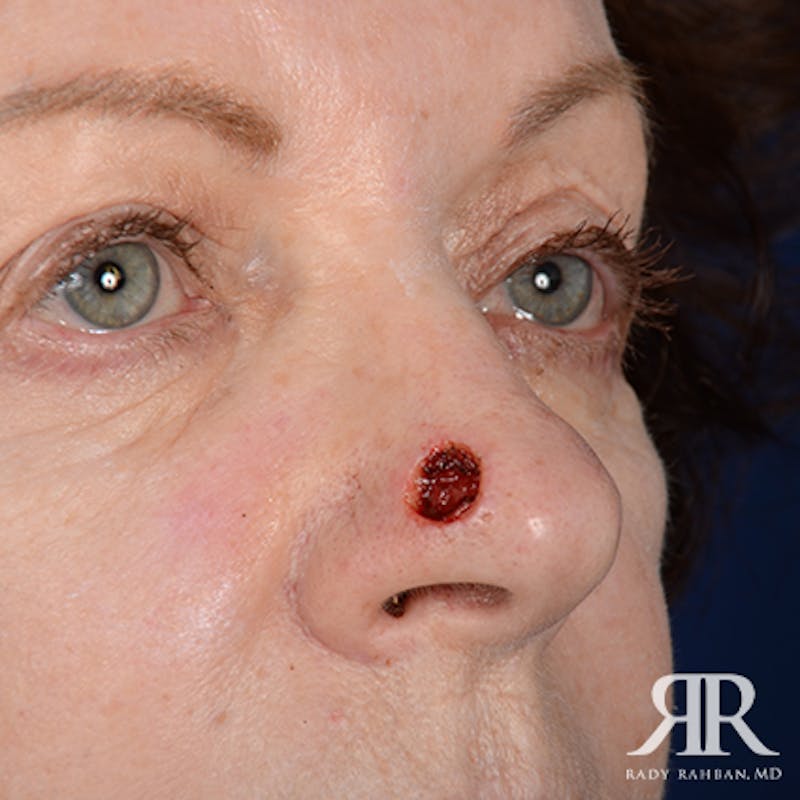 Mohs Surgery Before & After Gallery - Patient 329108 - Image 3