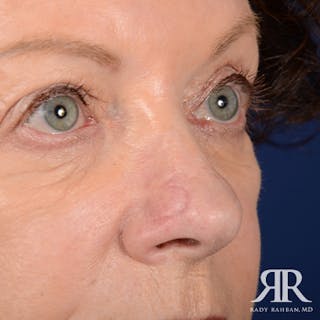 Mohs Surgery Before & After Gallery - Patient 329108 - Image 4