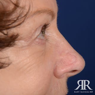 Mohs Surgery Before & After Gallery - Patient 329108 - Image 6