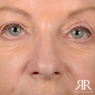 Mohs Surgery Before & After Gallery - Patient 329108 - Image 2