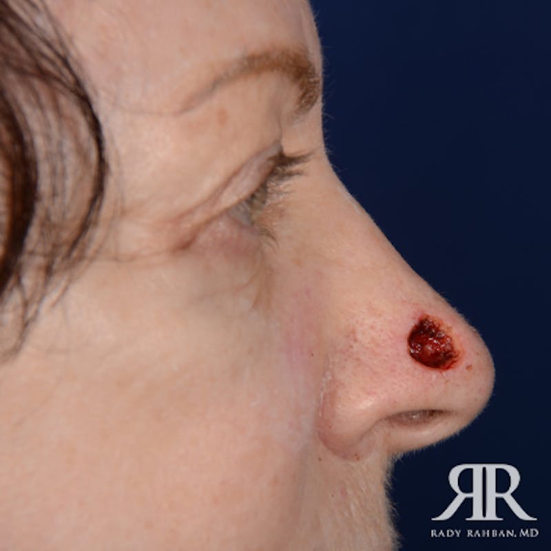 Mohs Surgery Before & After Gallery - Patient 329108 - Image 5