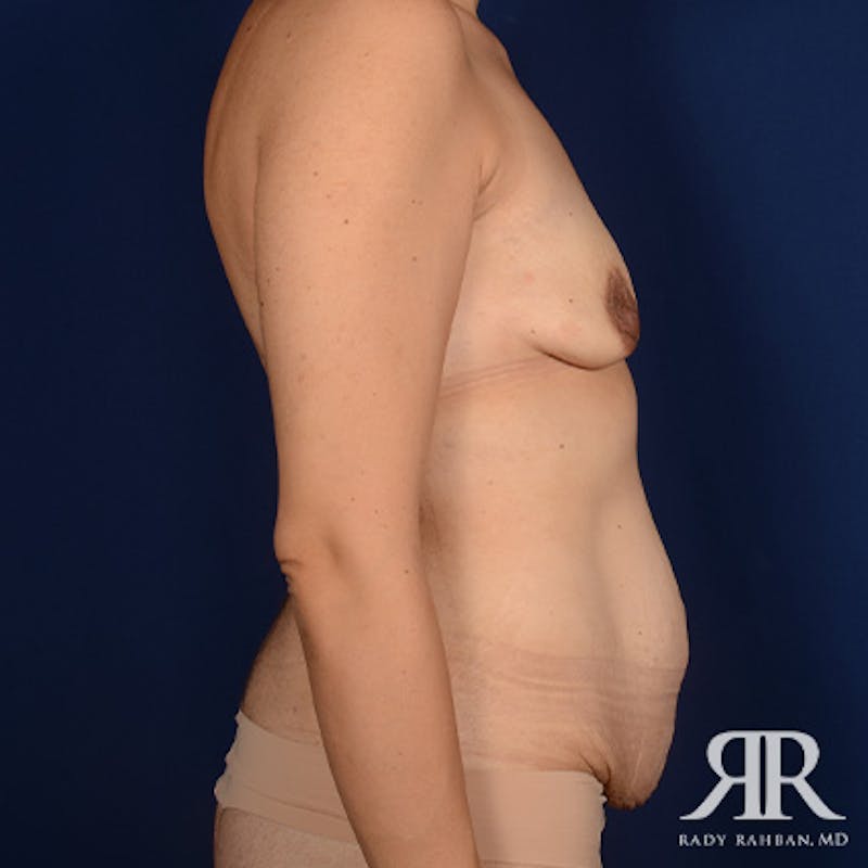 Mommy Makeover Before & After Gallery - Patient 356776 - Image 5
