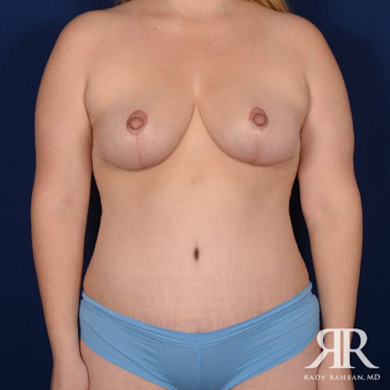 Mommy Makeover Before & After Gallery - Patient 381994 - Image 2