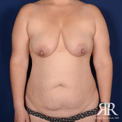 Mommy Makeover Before & After Gallery - Patient 381994 - Image 1