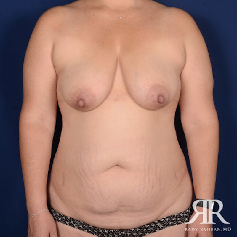 Mommy Makeover Before & After Gallery - Patient 381994 - Image 1
