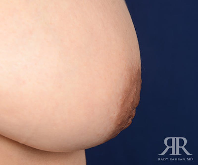 Inverted Nipple Before & After Gallery - Patient 352362 - Image 7
