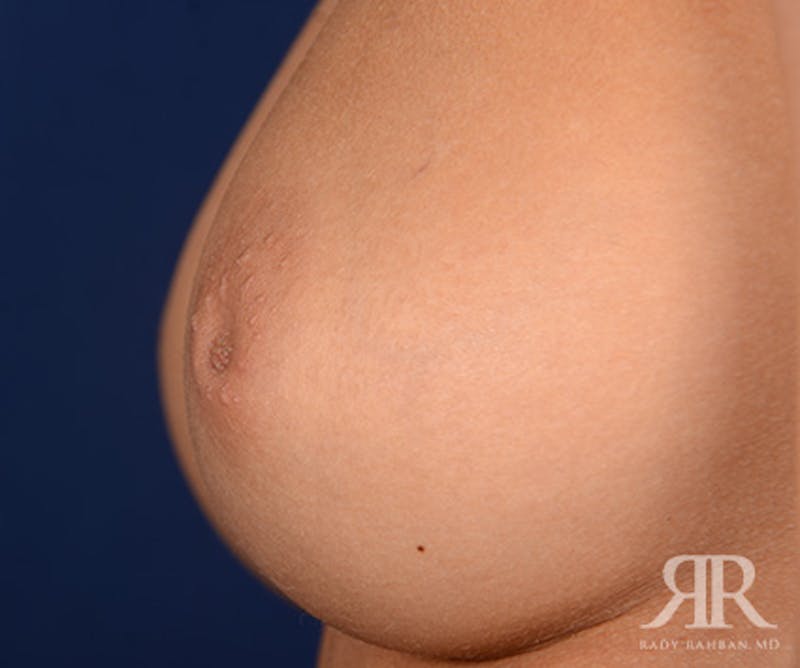 Inverted Nipple Before & After Gallery - Patient 140013 - Image 3