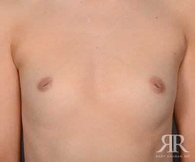 Inverted Nipple Before & After Gallery - Patient 258118 - Image 1