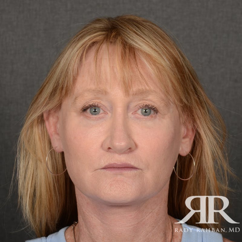 Facelift Before & After Gallery - Patient 166007 - Image 2
