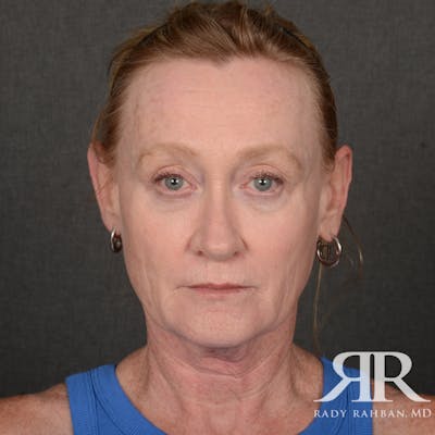 Facelift Before & After Gallery - Patient 166007 - Image 1
