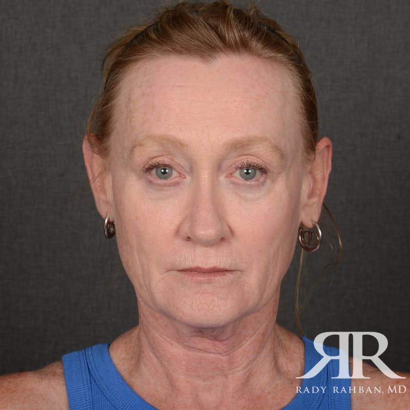 Facelift Before & After Gallery - Patient 166007 - Image 1