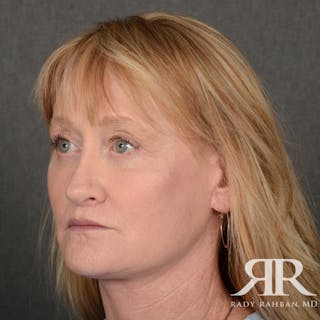 Facelift Before & After Gallery - Patient 166007 - Image 4