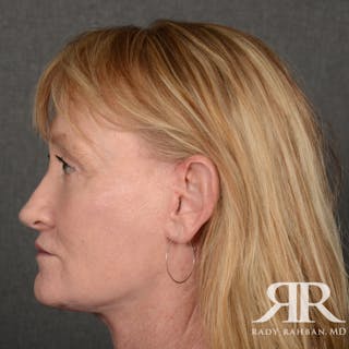 Facelift Before & After Gallery - Patient 166007 - Image 6