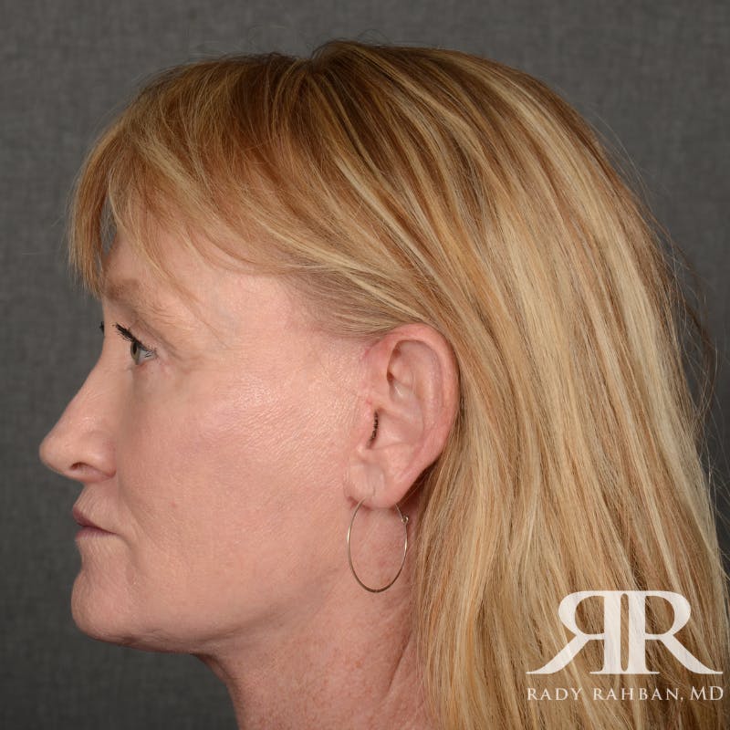 Facelift Before & After Gallery - Patient 166007 - Image 6