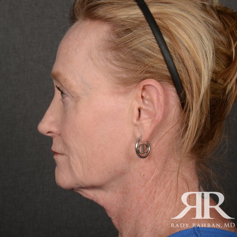 Facelift Before & After Gallery - Patient 166007 - Image 5