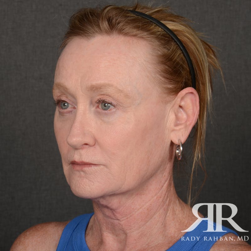 Facelift Before & After Gallery - Patient 166007 - Image 3