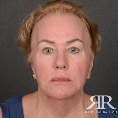 Facelift Before & After Gallery - Patient 904912 - Image 1
