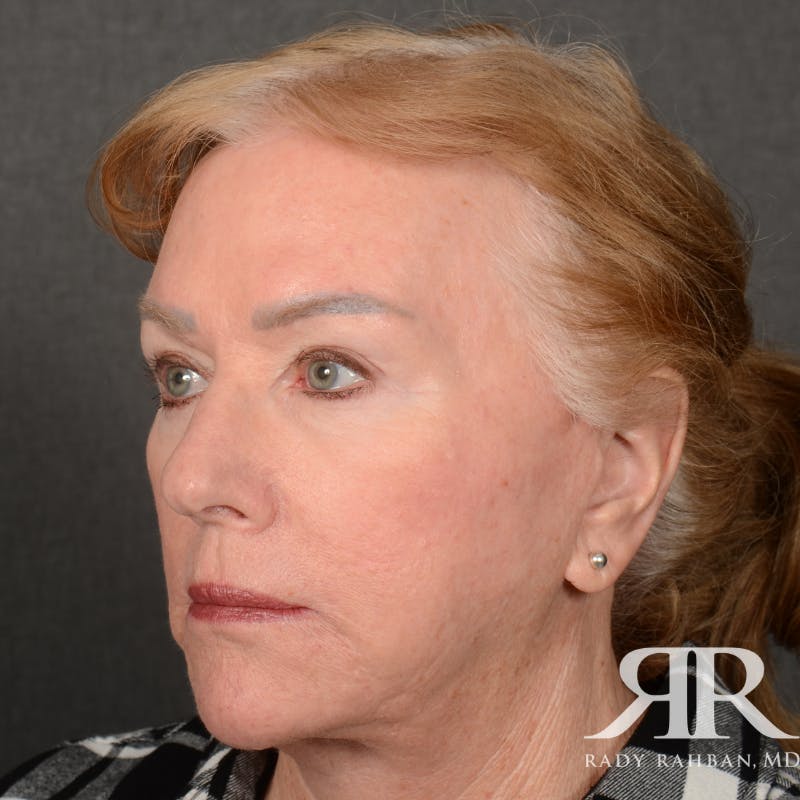 Facelift Before & After Gallery - Patient 904912 - Image 4