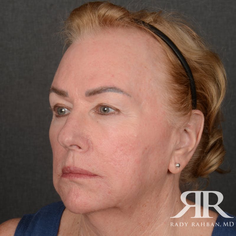 Facelift Before & After Gallery - Patient 904912 - Image 3