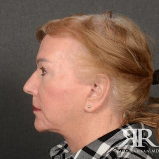 Facelift Before & After Gallery - Patient 904912 - Image 6