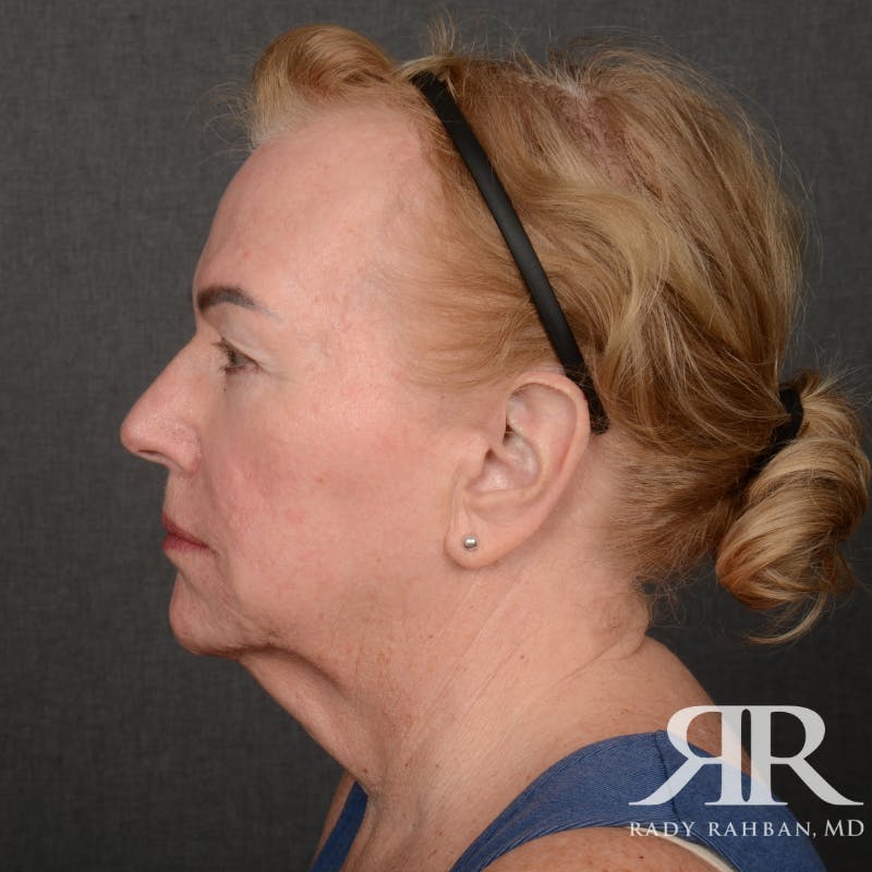 Facelift Before & After Gallery - Patient 904912 - Image 5