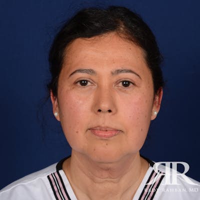 Facelift Before & After Gallery - Patient 419967 - Image 1