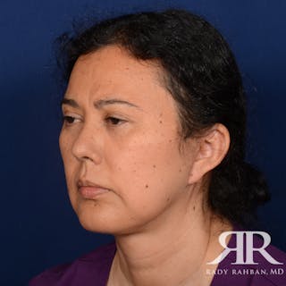 Facelift Before & After Gallery - Patient 419967 - Image 4