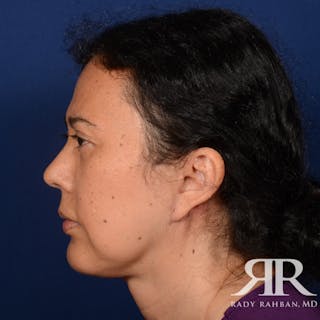 Facelift Before & After Gallery - Patient 419967 - Image 6